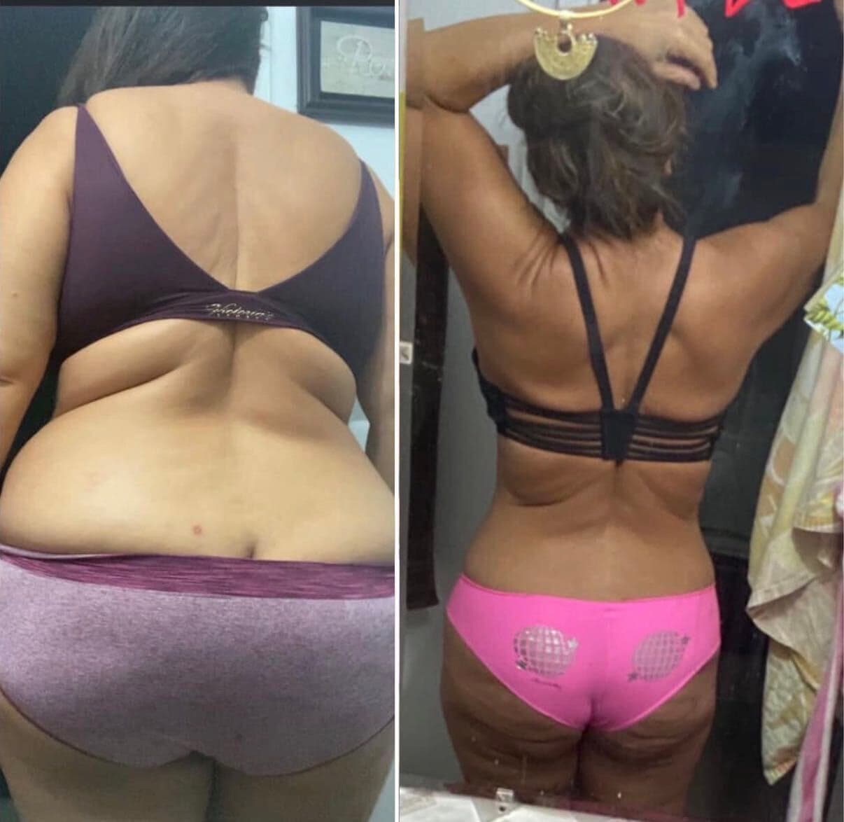 Back-view before and after of the same member, showing a slimmer, more defined back and waist.